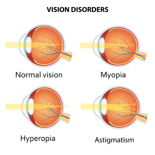 Corneal Diseases